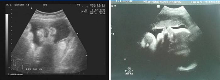 Ultragarsas pilvo srityje 36 nėštumo savaitę