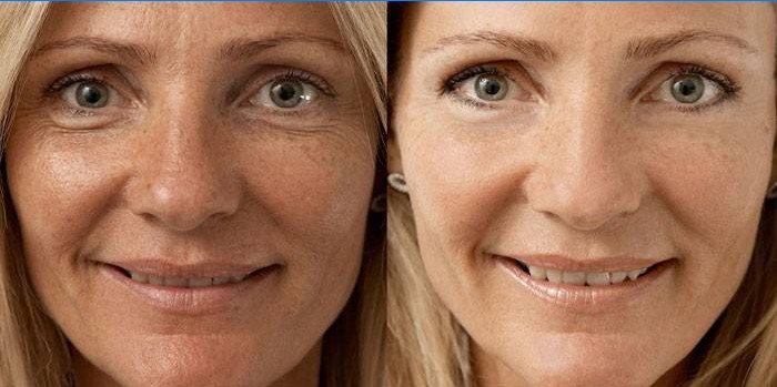 Moters nuotrauka prieš ir po biorevitalizacijos