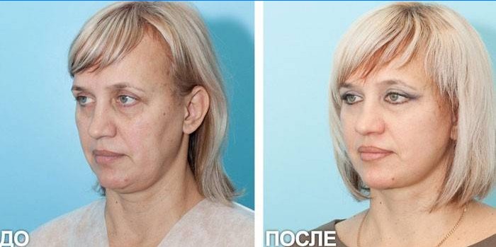Moters nuotrauka prieš ir po SMAS kėlimo