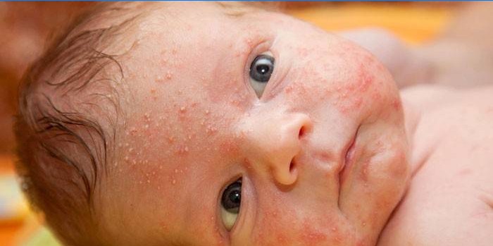 Hormoninis bėrimas kūdikiui ant veido