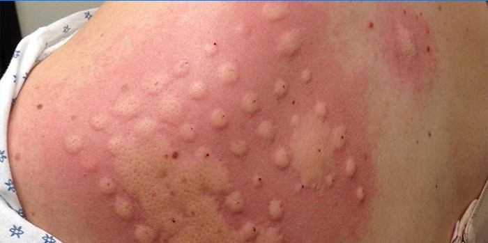 Alerginės odos tyrimas