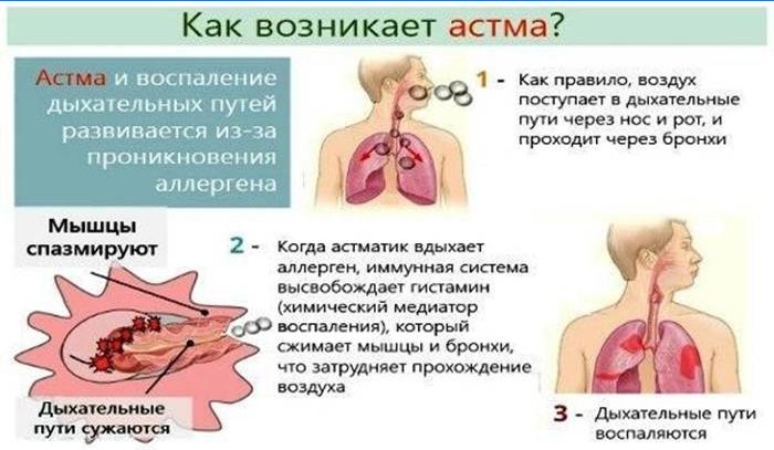 Kaip pasireiškia astma?