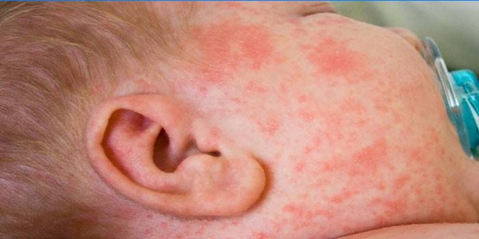 Alerginis bėrimas ant vaiko veido