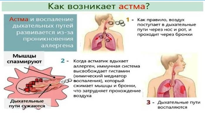Kaip pasireiškia astma?